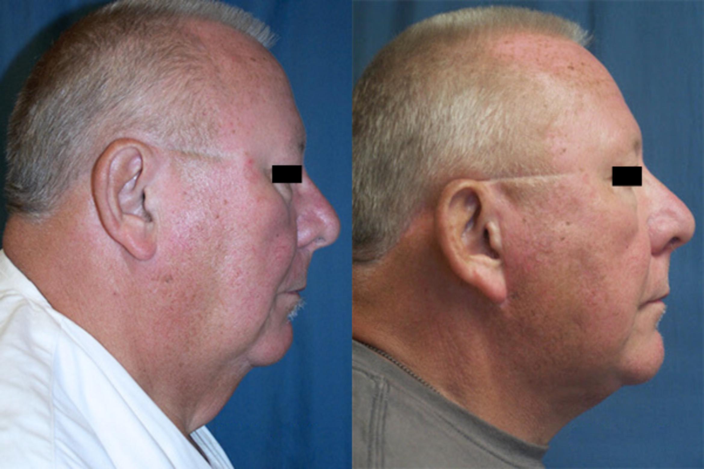 Before & After Necklift Case 3178 View 1 View in Virginia Beach, VA