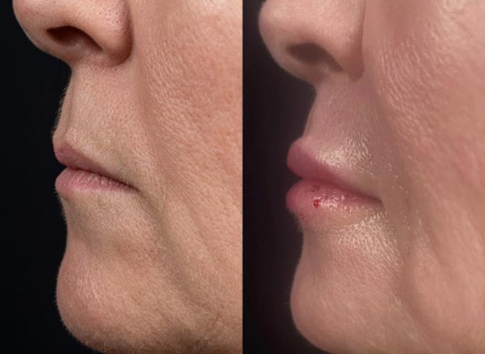 Before & After PRP Case 60655 Left Side View in Virginia Beach, VA