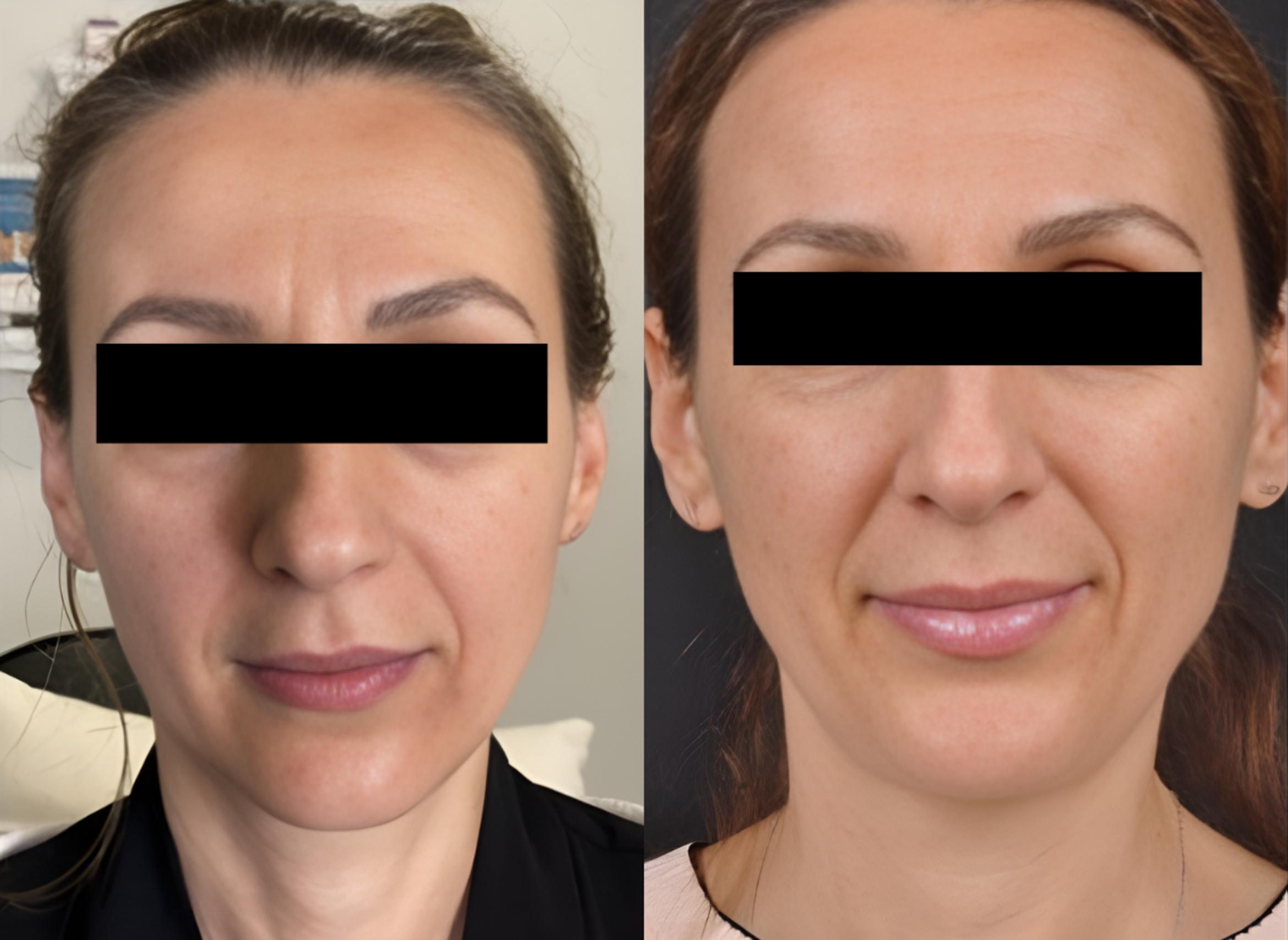 Before & After Restylane® Kysse Case 27533 View 1 View in Virginia Beach, VA