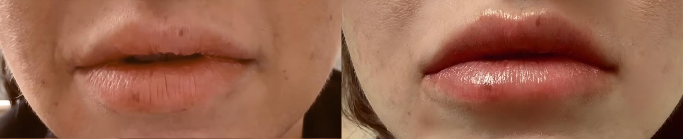 Before & After Restylane® Kysse Case 60635 Lips View in Virginia Beach, VA