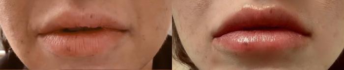 Before & After Restylane® Kysse Case 60635 Lips View in Virginia Beach, VA