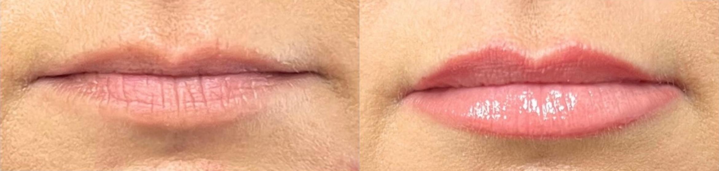 Before & After Restylane® Kysse Case 60643 Front View in Virginia Beach, VA