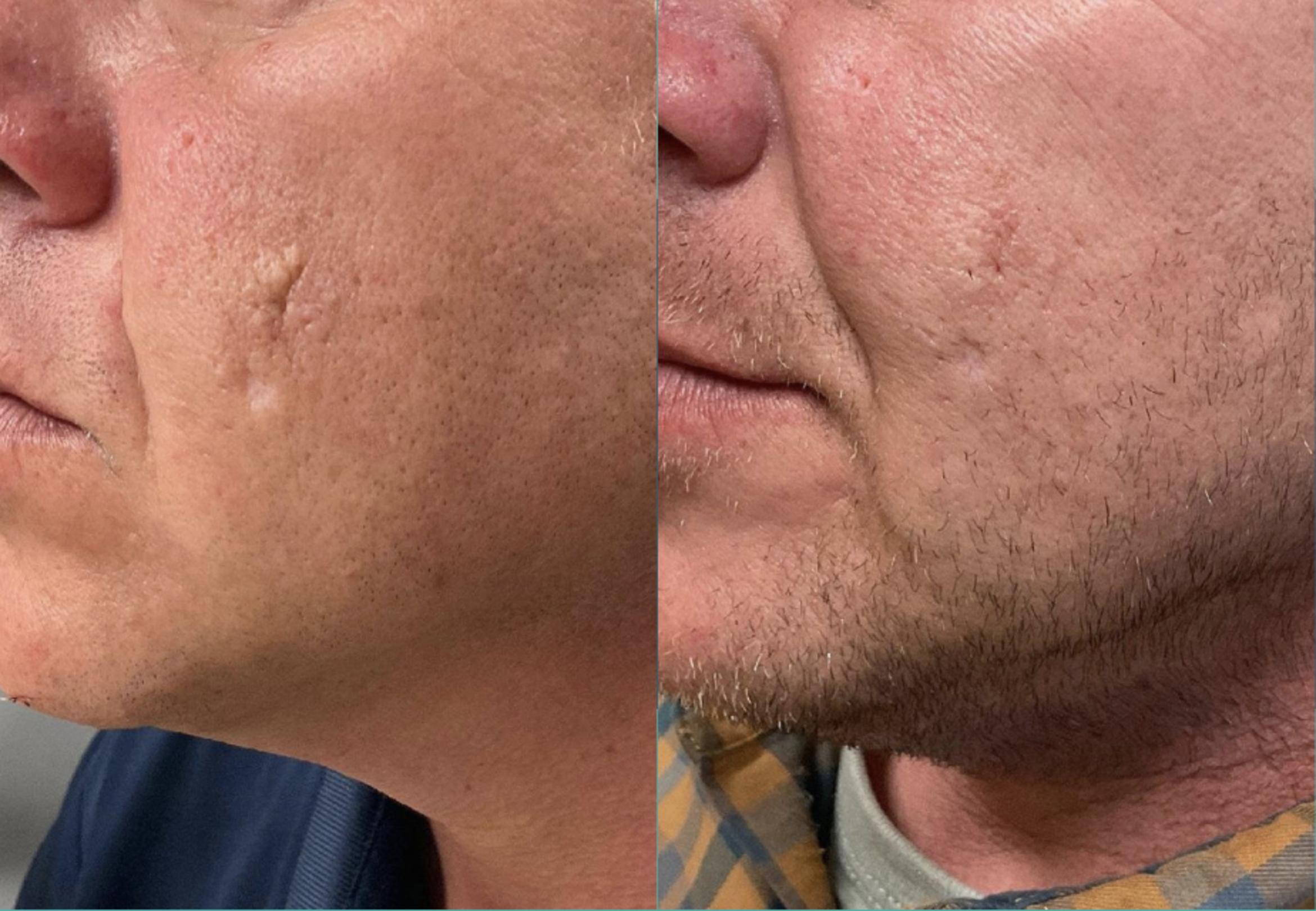 Before & After Scar Removal Case 12 View 1 View in Virginia Beach, VA