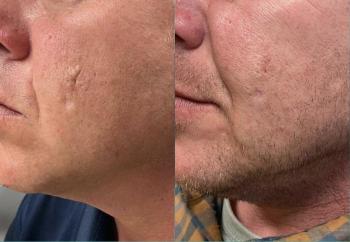 Before & After Scar Removal Case 12 View 1 View in Virginia Beach, VA