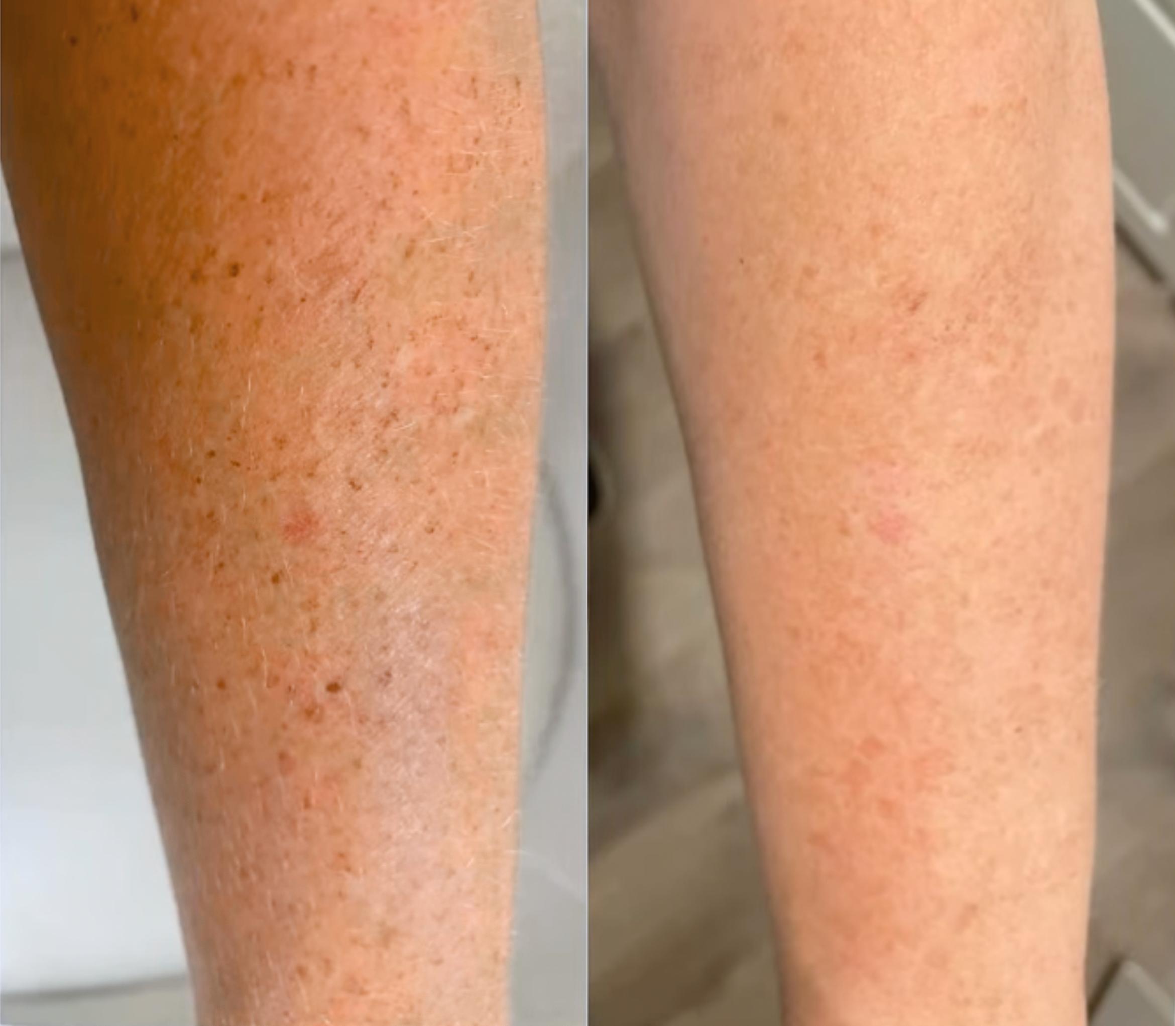 Before & After Sciton MOXI® Case 60633 Front View in Virginia Beach, VA