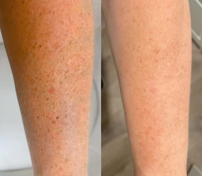 Before & After Sciton MOXI® Case 60633 Front View in Virginia Beach, VA