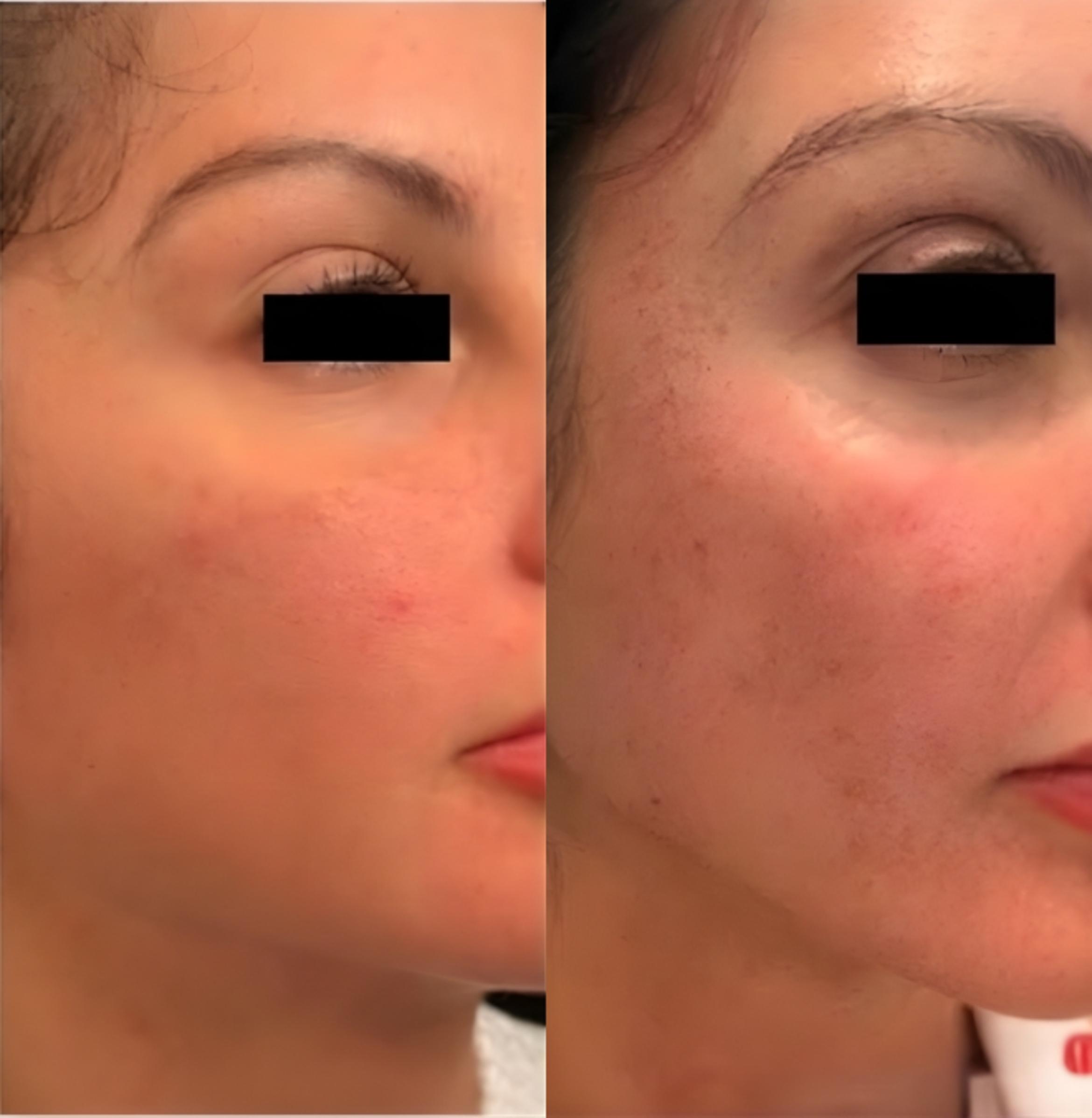Before & After Sciton MOXI® Case 60647 Left Side View in Virginia Beach, VA