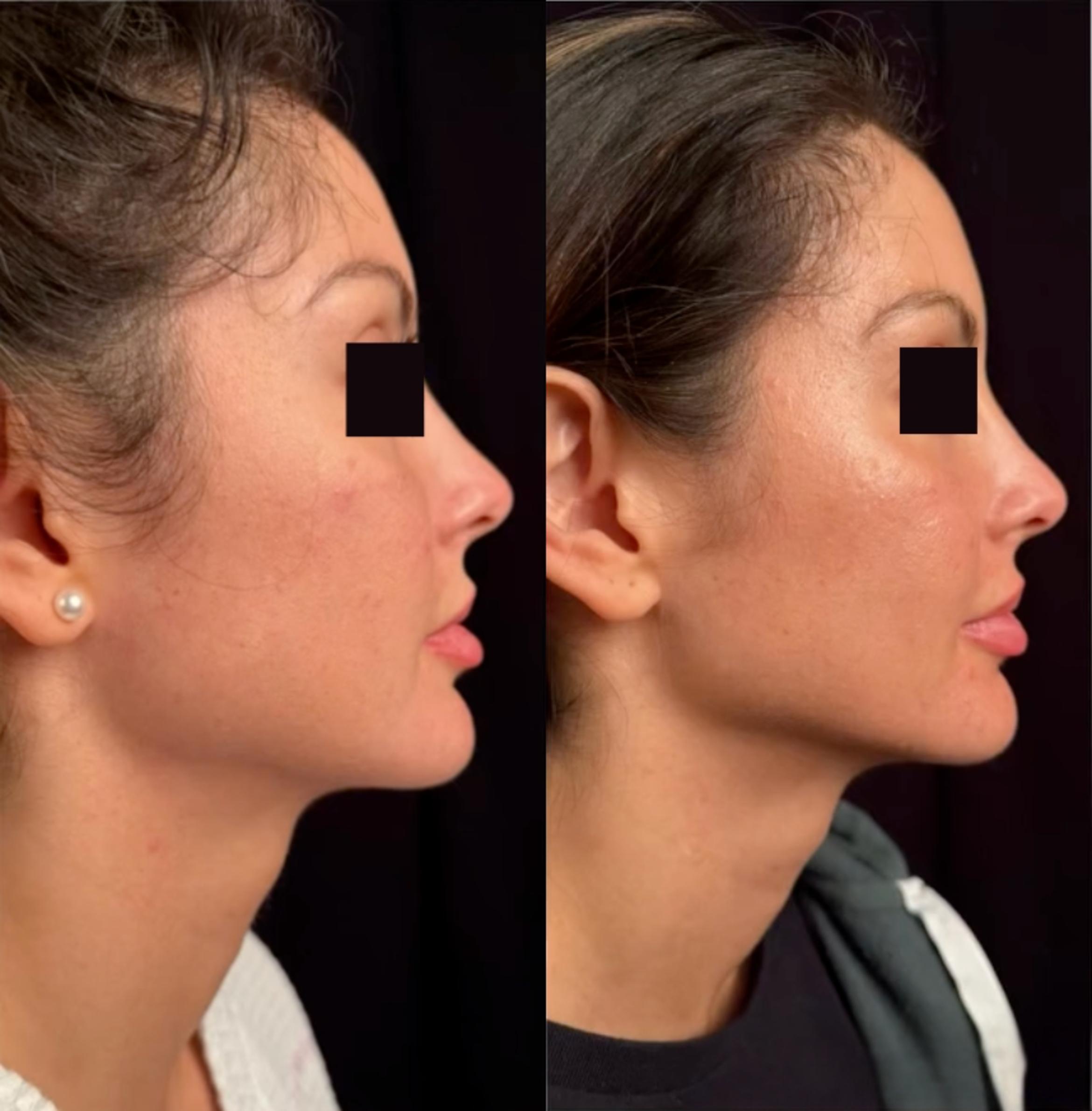 Before & After Sciton MOXI® Case 60658 Right Side View in Virginia Beach, VA