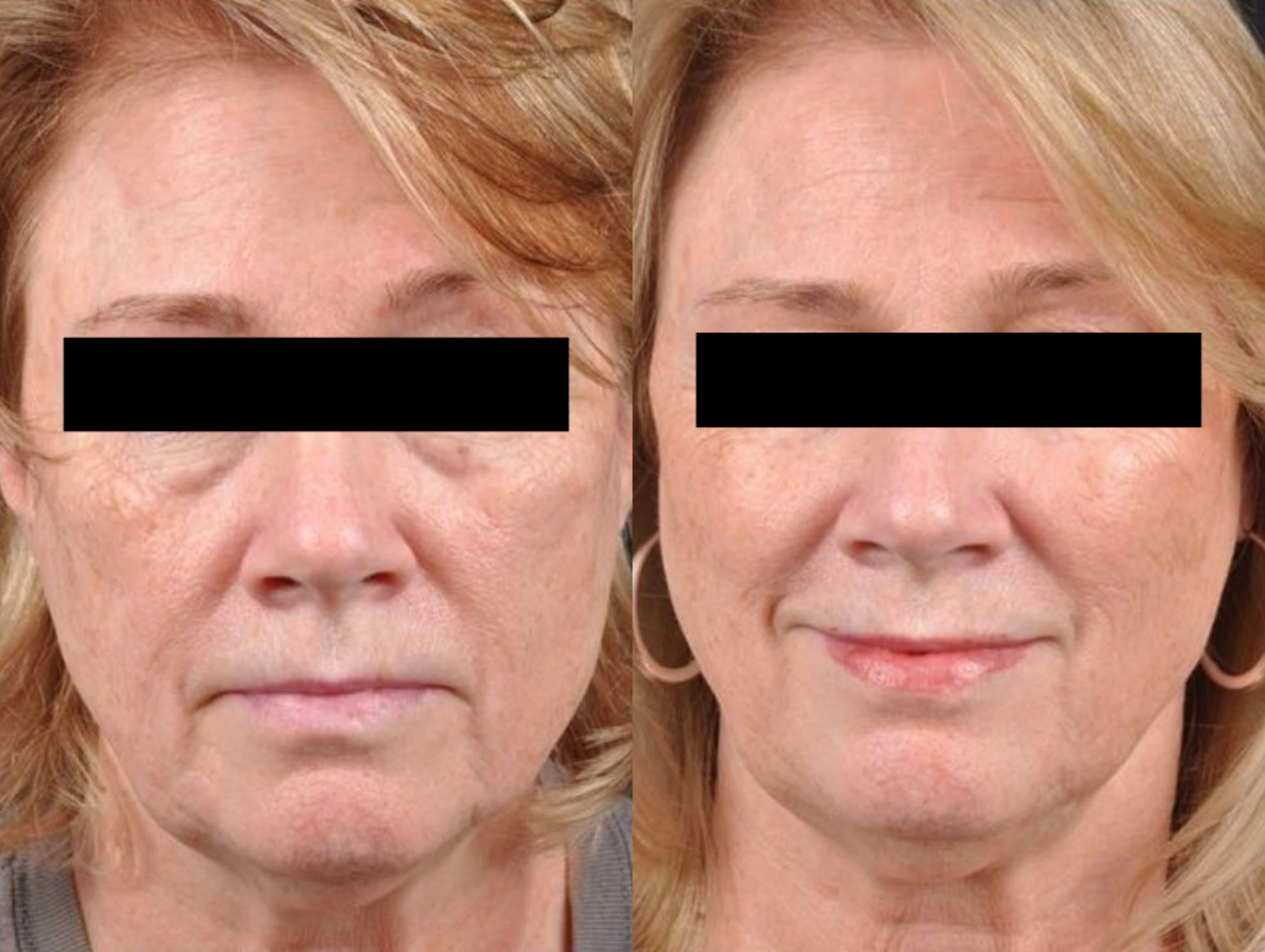 Before & After Sculptra Case 27529 View 1 View in Virginia Beach, VA