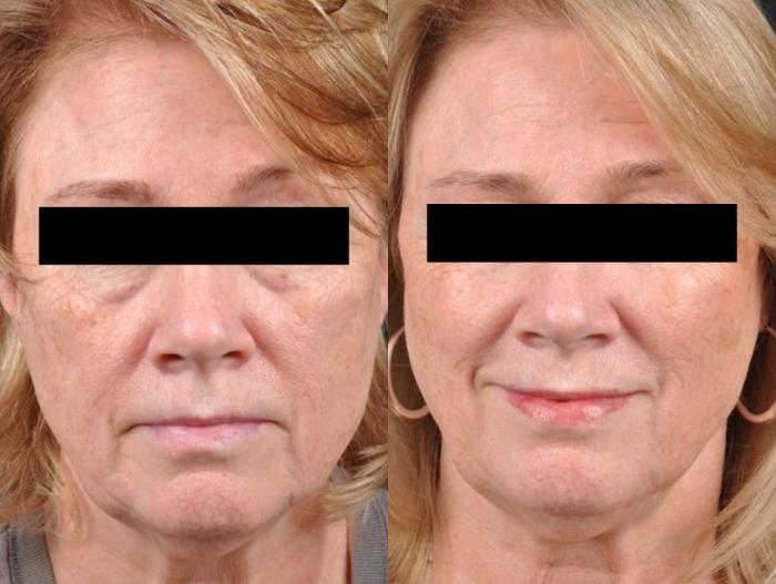 Before & After Sculptra Case 27529 View 1 View in Virginia Beach, VA